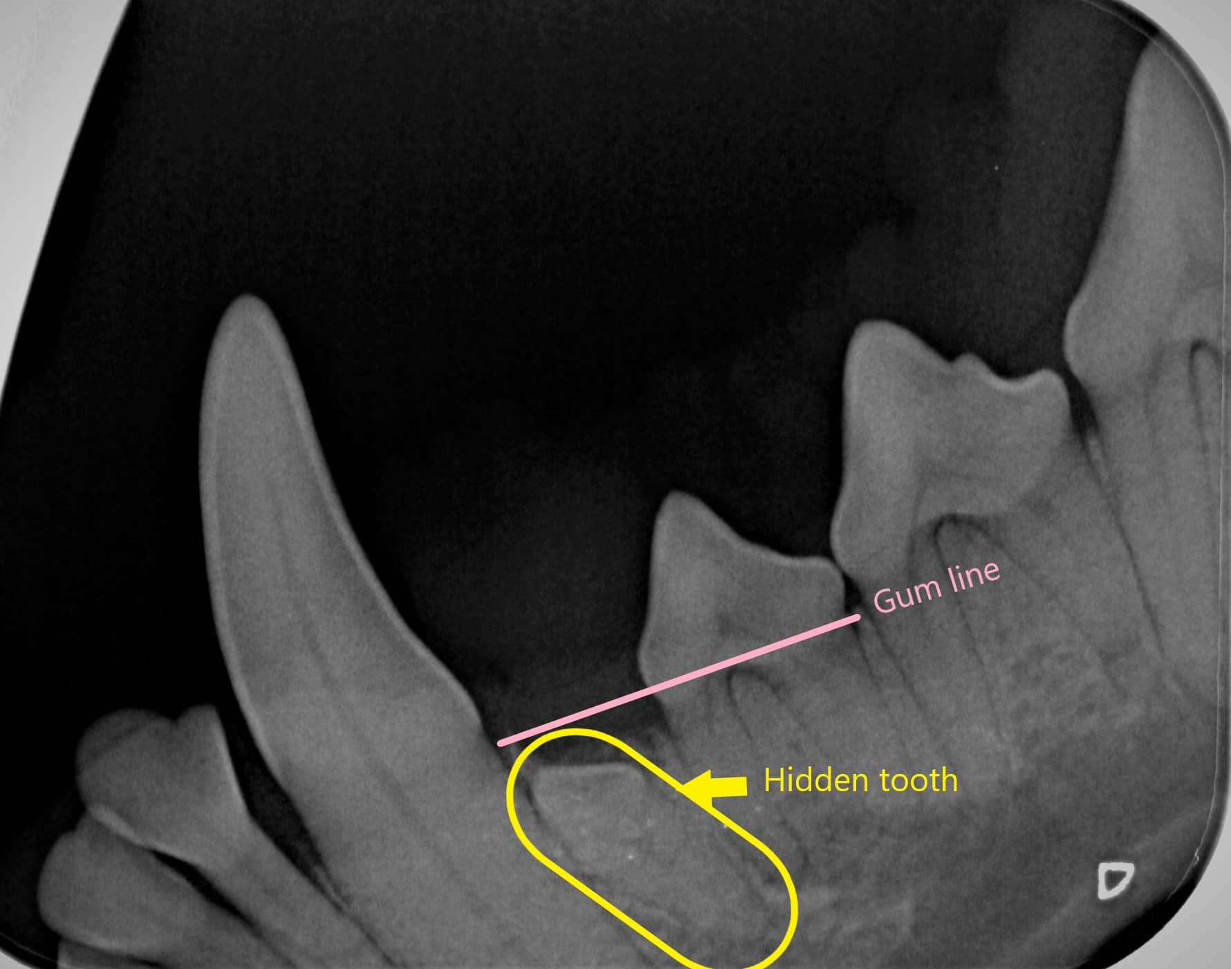 X-ray of unerupted tooth